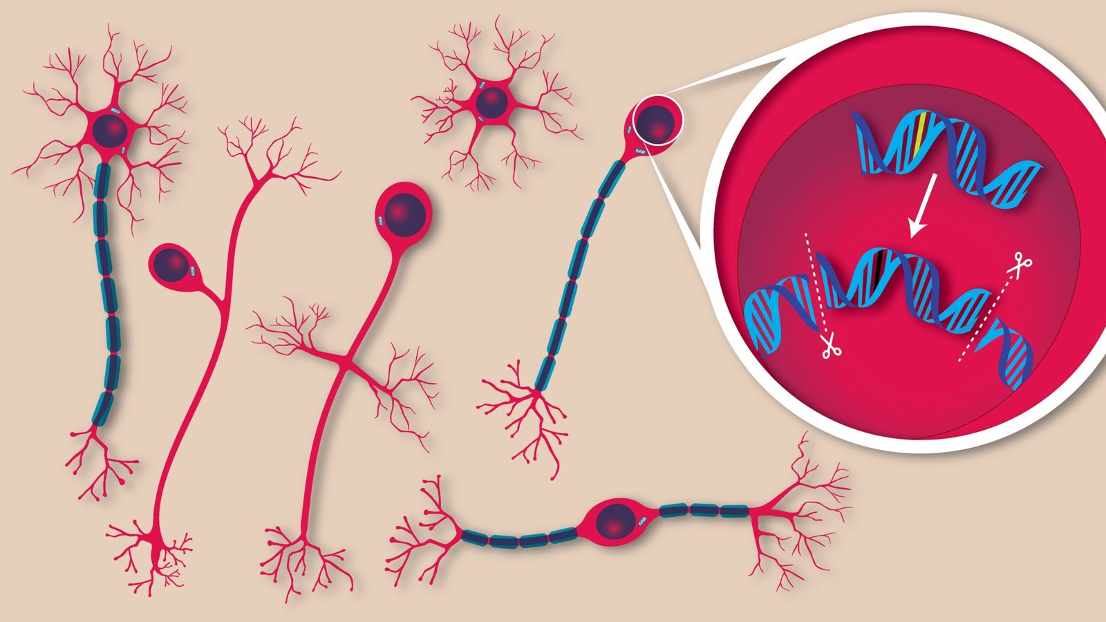 prime-editing-reverses-childhood-brain-disorder-in-mouse-model