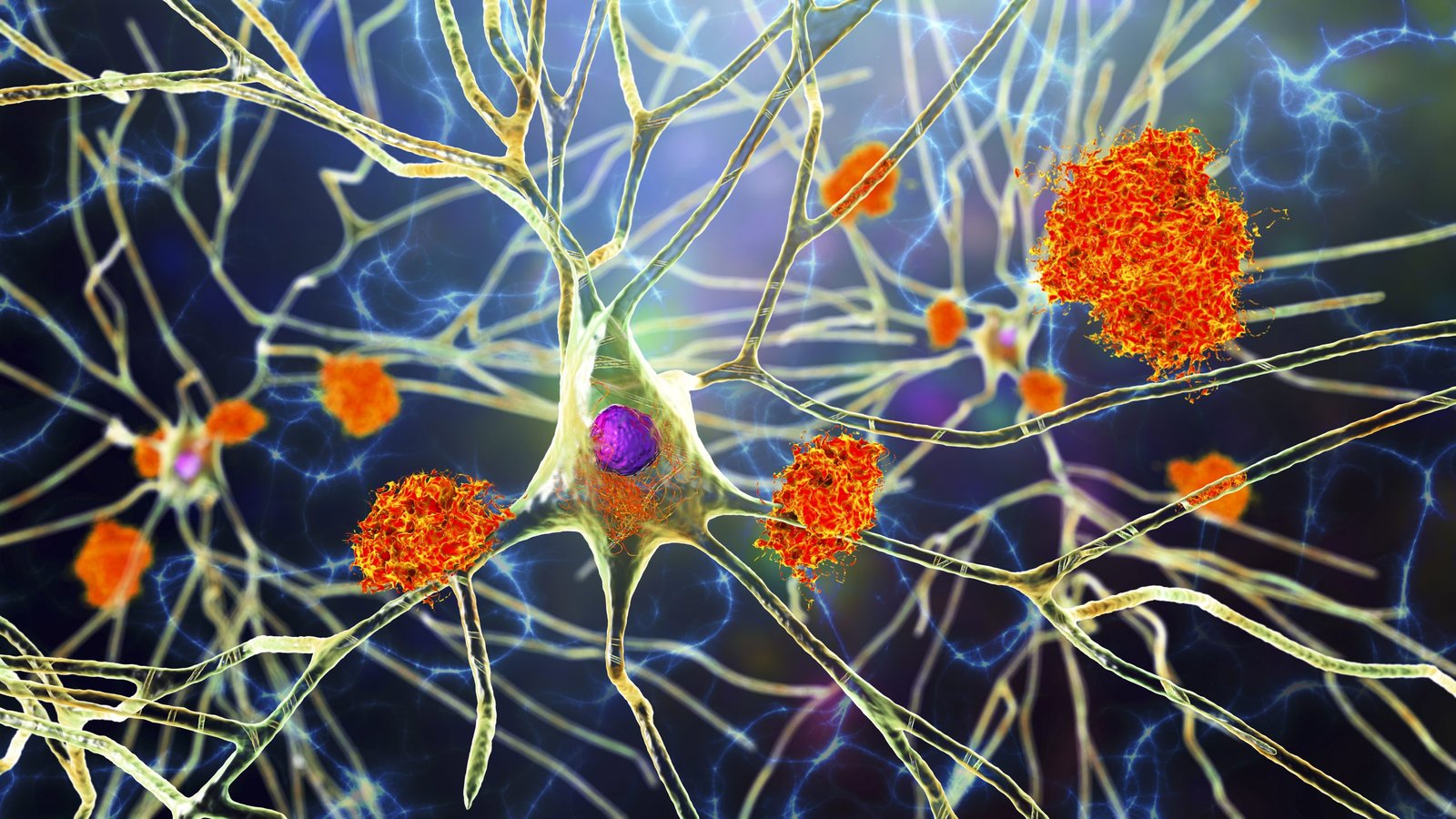 alzheimer’s-mouse-model-shows-memory-boost-from-anticancer-drug-combo