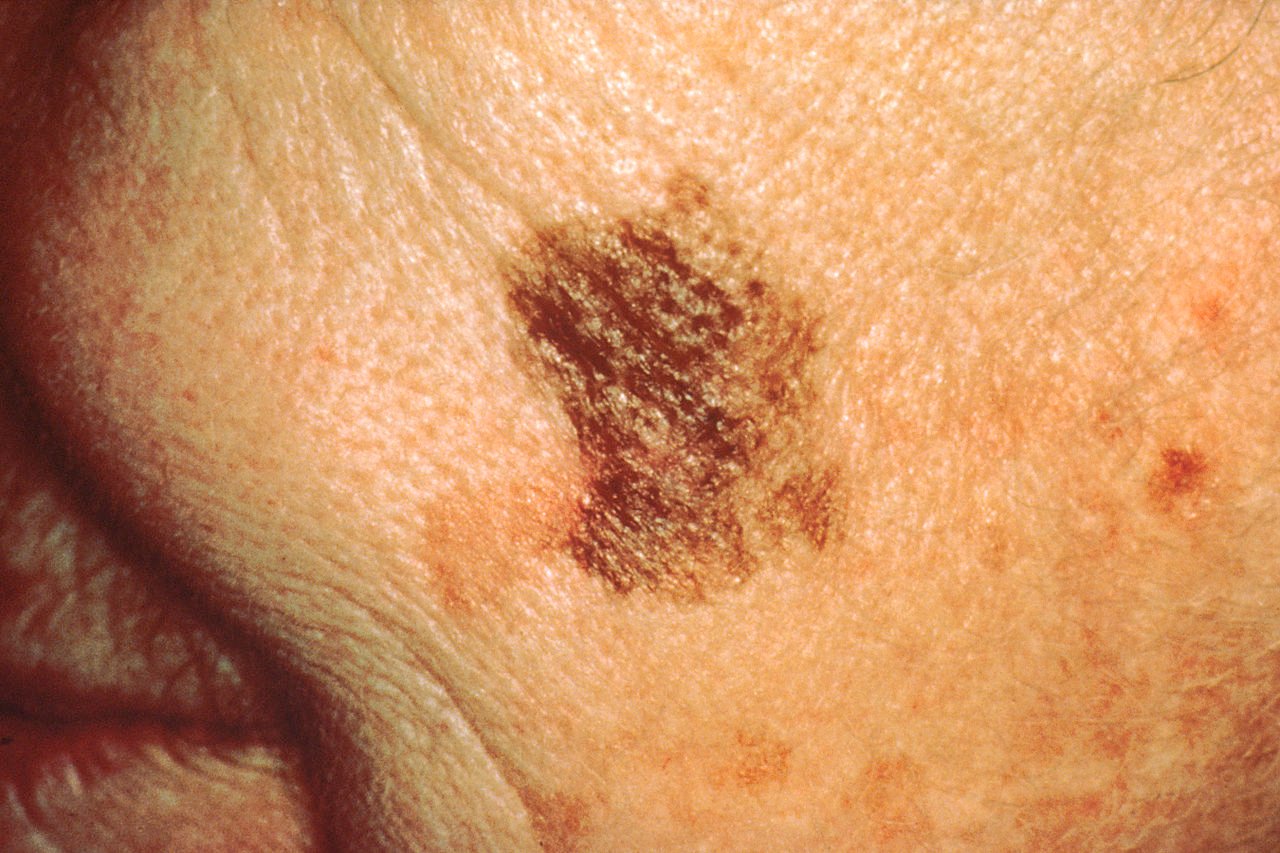 melanoma-cells-in-mice-steered-by-protein’s-unexpected-function