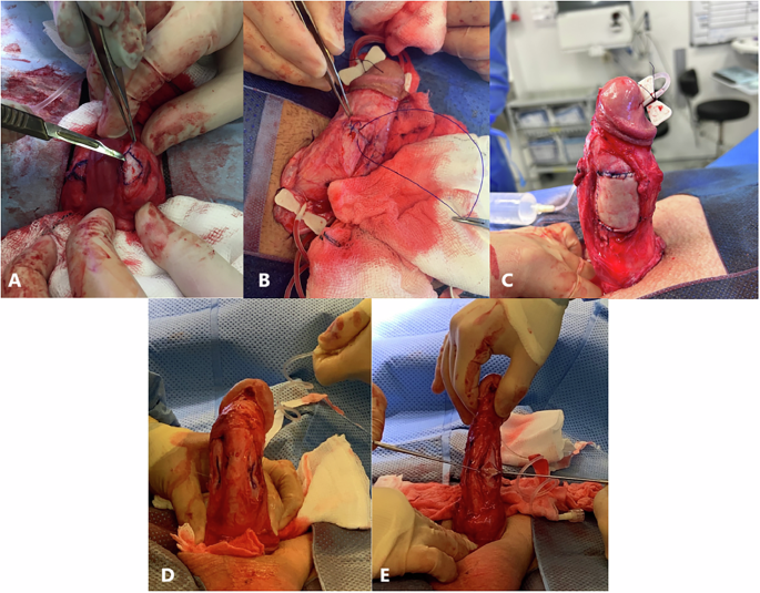 the-evolution-of-penile-reconstructive-techniques-in-urology