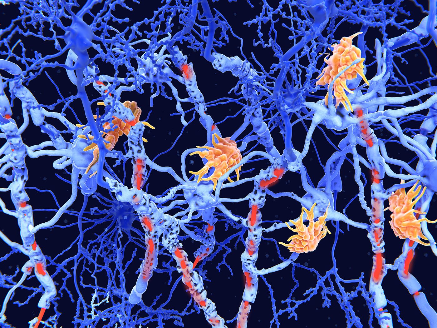 unusual-brain-cell-type-linked-to-progressive-ms,-could-point-to-therapeutics