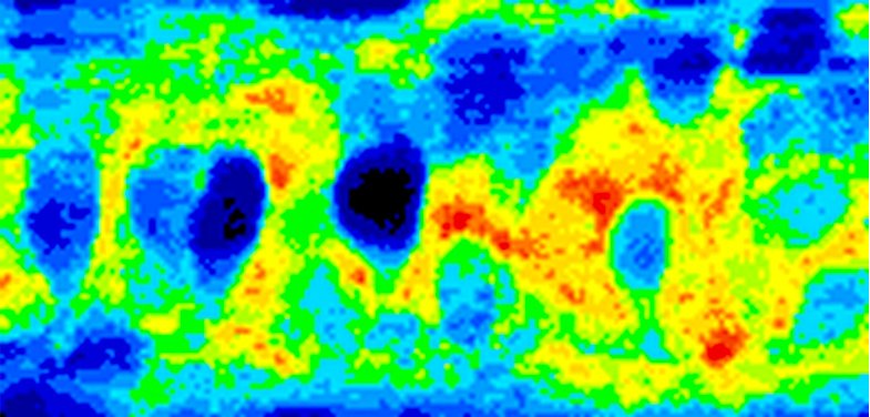 als-linked-to-proteostatic-burden-in-vulnerable-motor-neurons