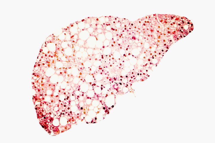 high-fat-diet-triggers-hepatocyte-dedifferentiation-and-cancer-risk