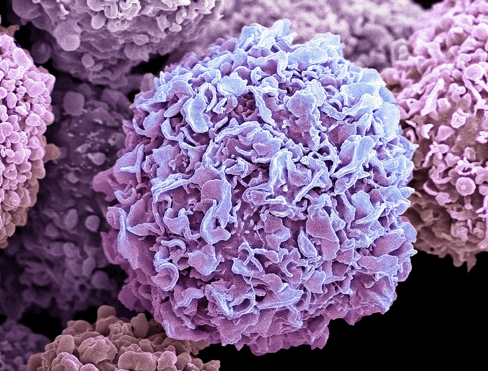 triple-negative-breast-cancer-cells-use-‘sticky-coat’-to-support-clustering,-metastasis