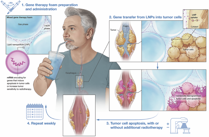 Drinkable gene therapy foam for the treatment of constrictive esophageal carcinoma
