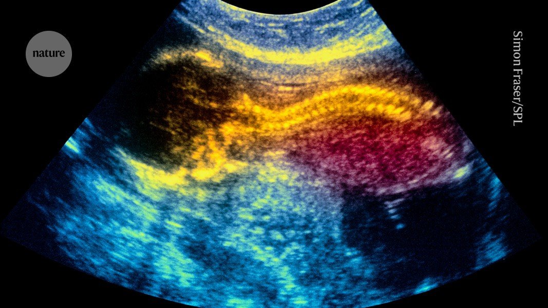 world-first-stem-cell-therapy-shows-promise-for-treating-spina-bifida-in-the-womb